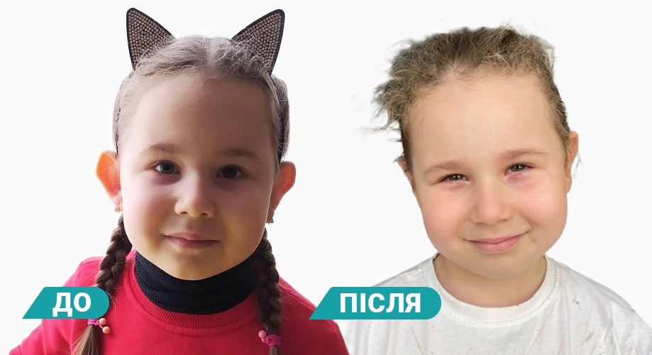 отопластика дітям до-після