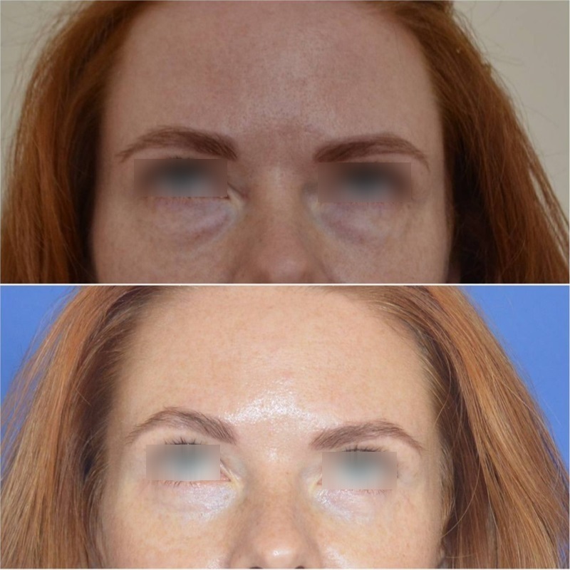 блефаропластика