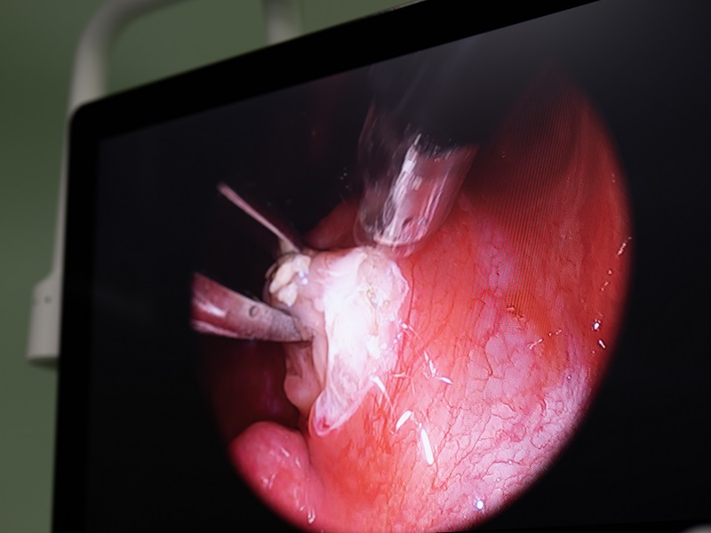 видалення пухлин ЛОР