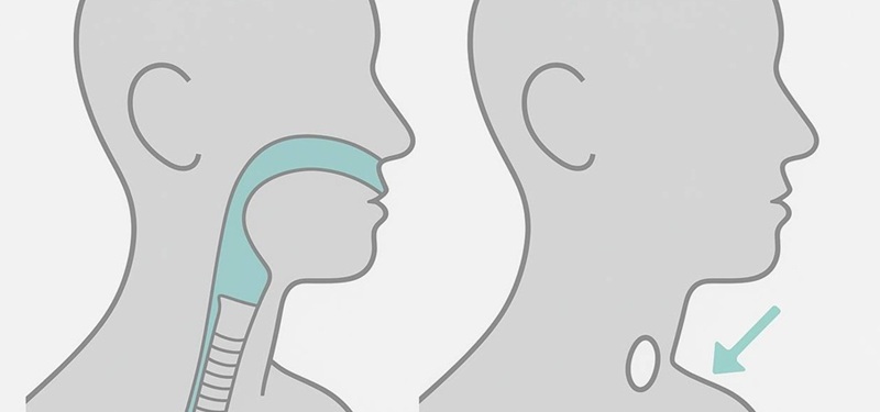 Ларингектомія в Києві ларингектомія