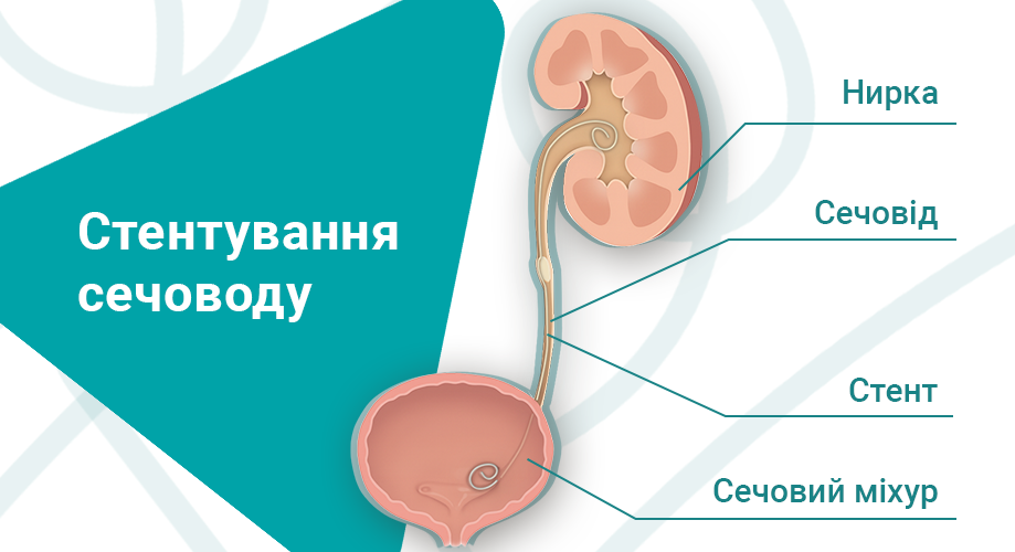 _Стентування_сечоводу_інфографіка_для_сайту.png стентування сечоводу