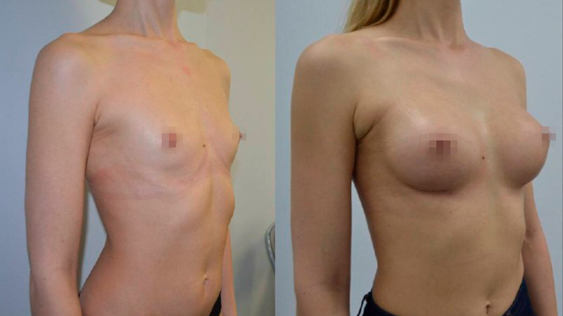 мамопластика