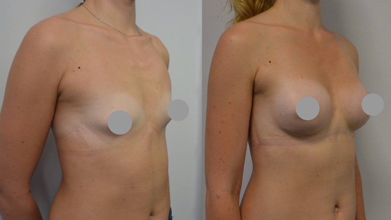 мамопластика