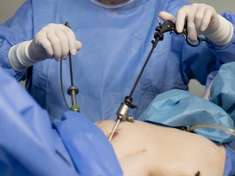 лапароскопія онко