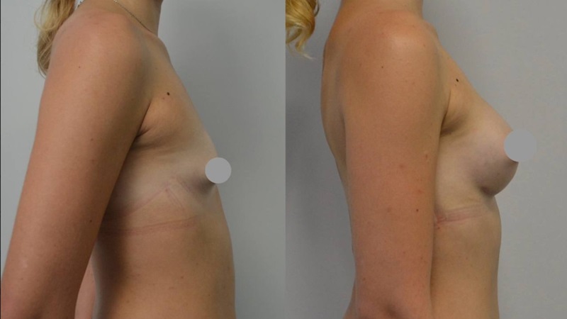 мамопластика