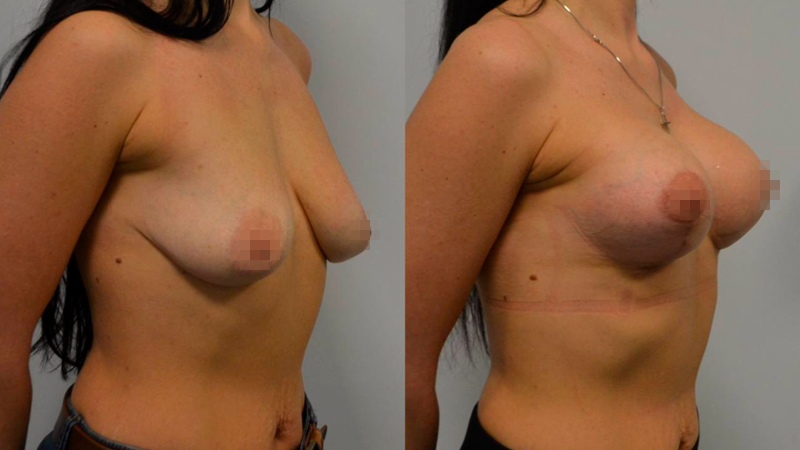 мамопластика