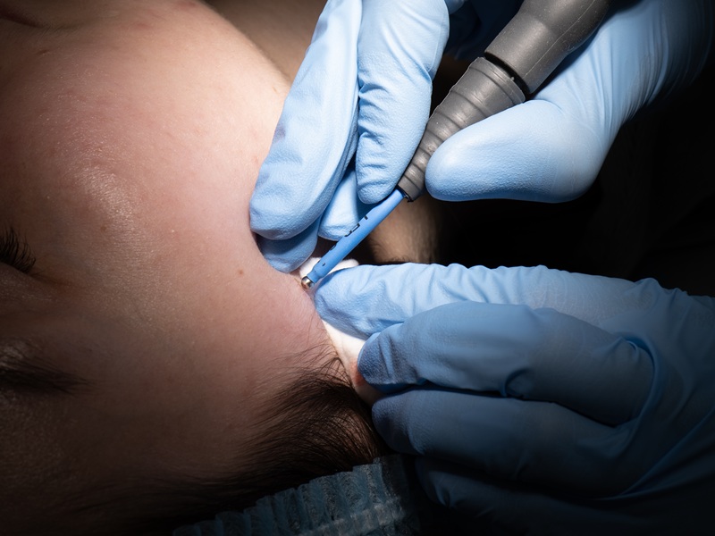 P1049272.jpg радіохвильове видалення родимок