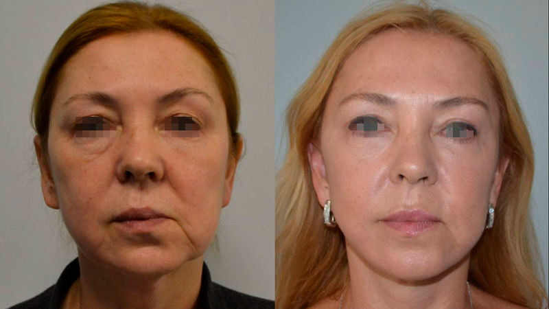 фейсліфтинг до після