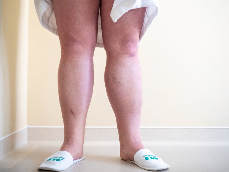 лікування виразки на ногах