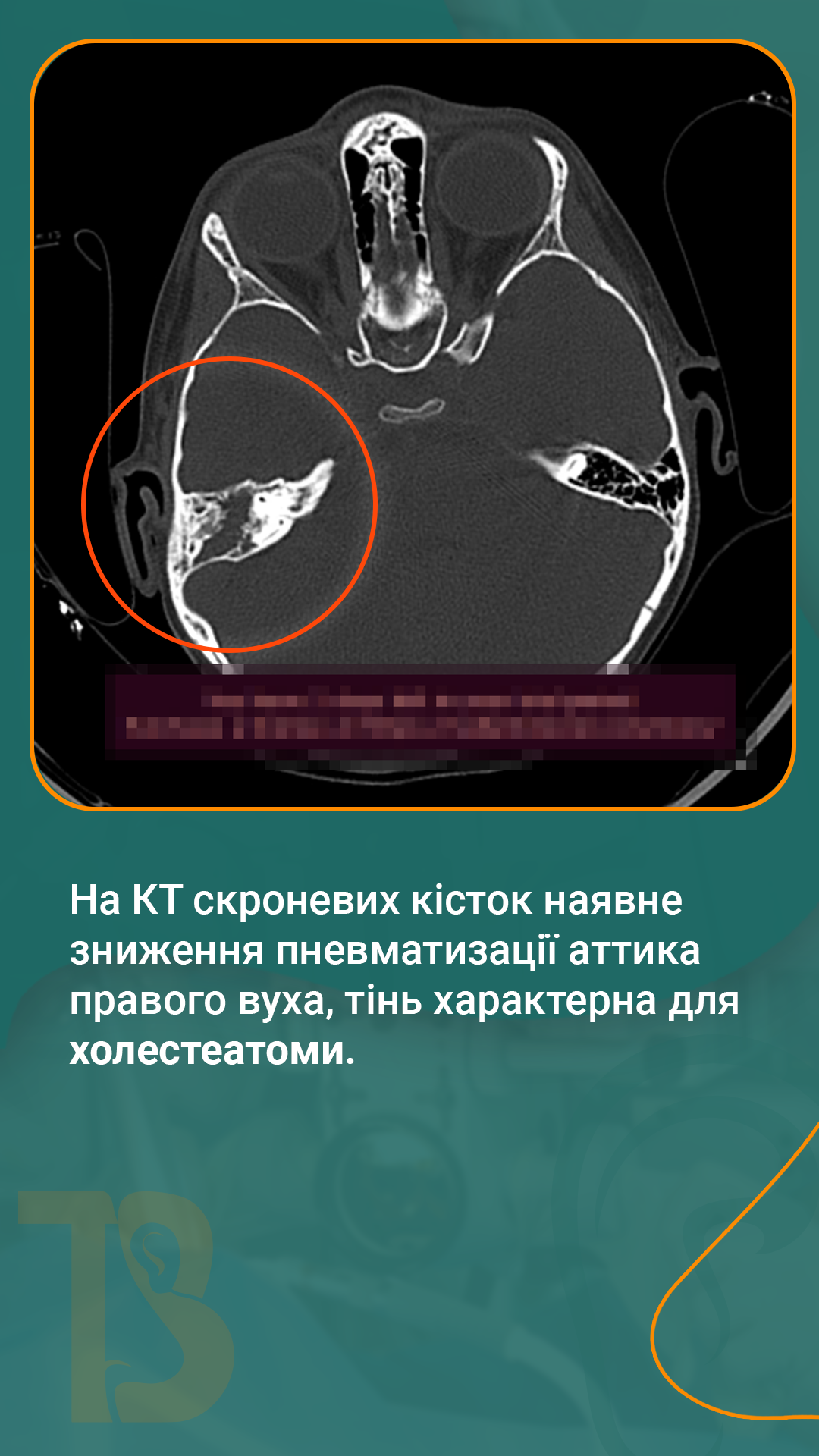 КТ уха