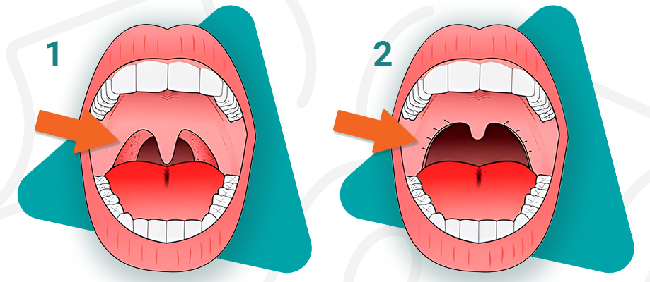 Види увулопалатопластики лікування храпу київ