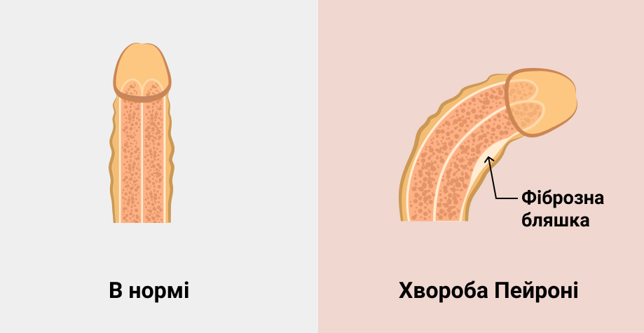 Лікування хвороби Пейроні в Києві