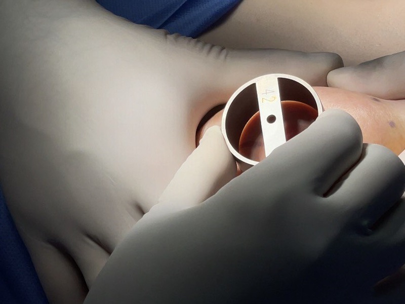 Як проходить операція по корекції сосків