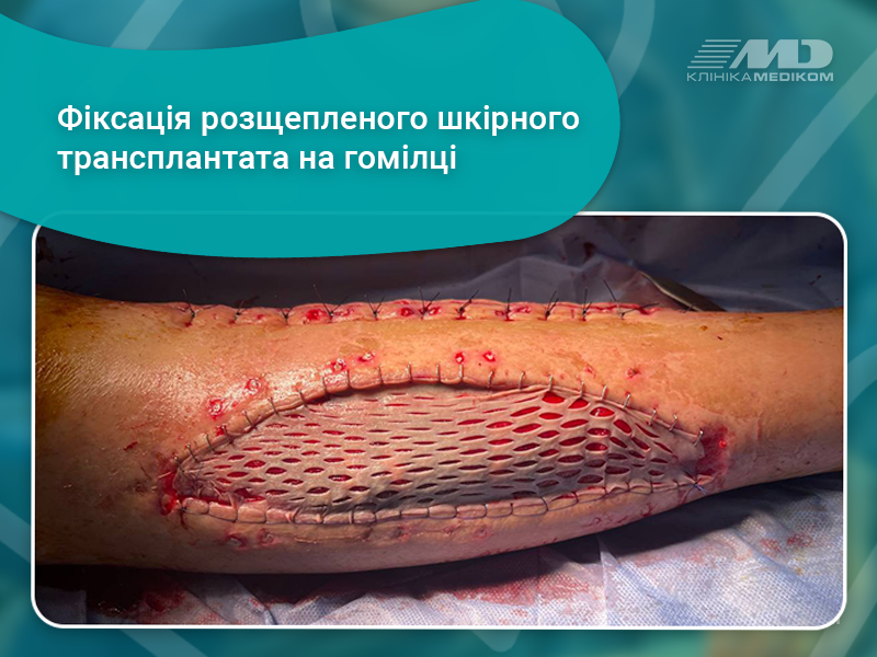 Аутодермопластика