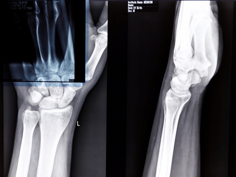 МРТ запястка МРТ запястка