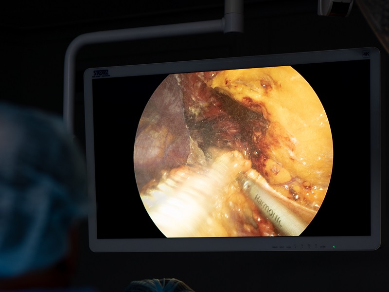 лапароскопическая операция