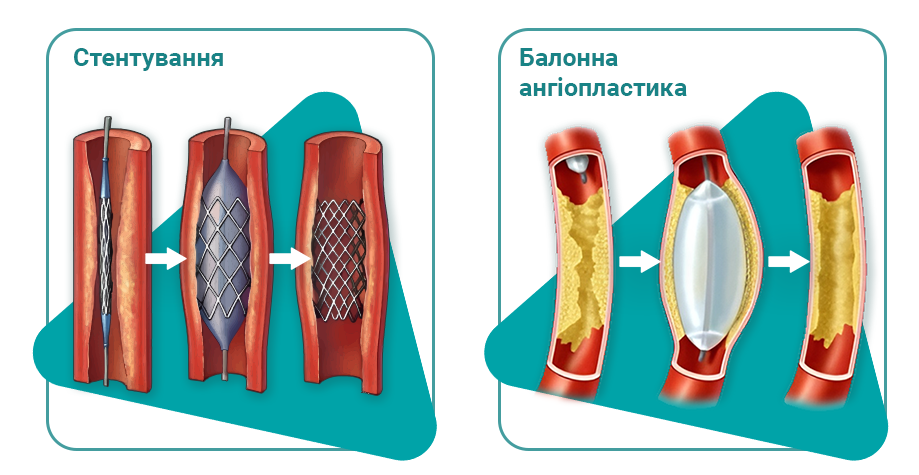 Ангіопластика судин нижніх кінцівок у Києві ангіопластика
