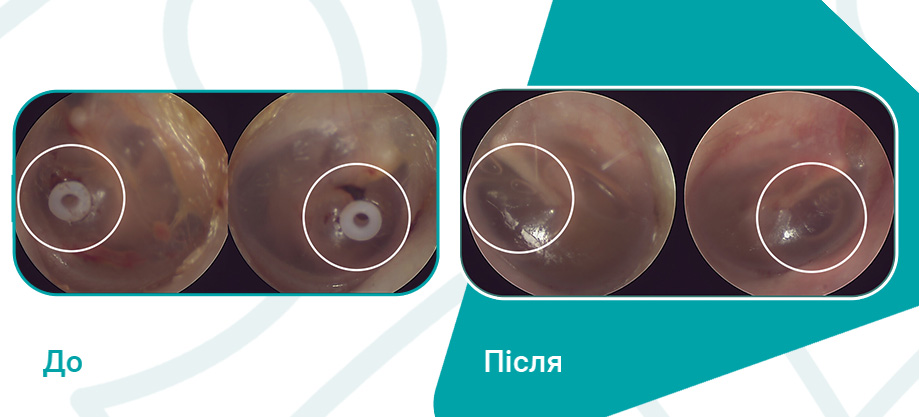 Шунтування.jpg Шунтування вуха