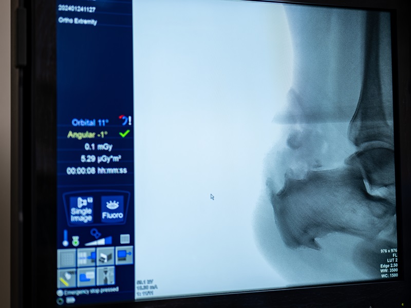 деформація хаглунда