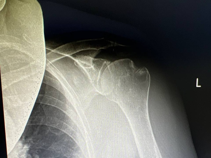 остеосинтез ПІСЛЯ остеосинтез після