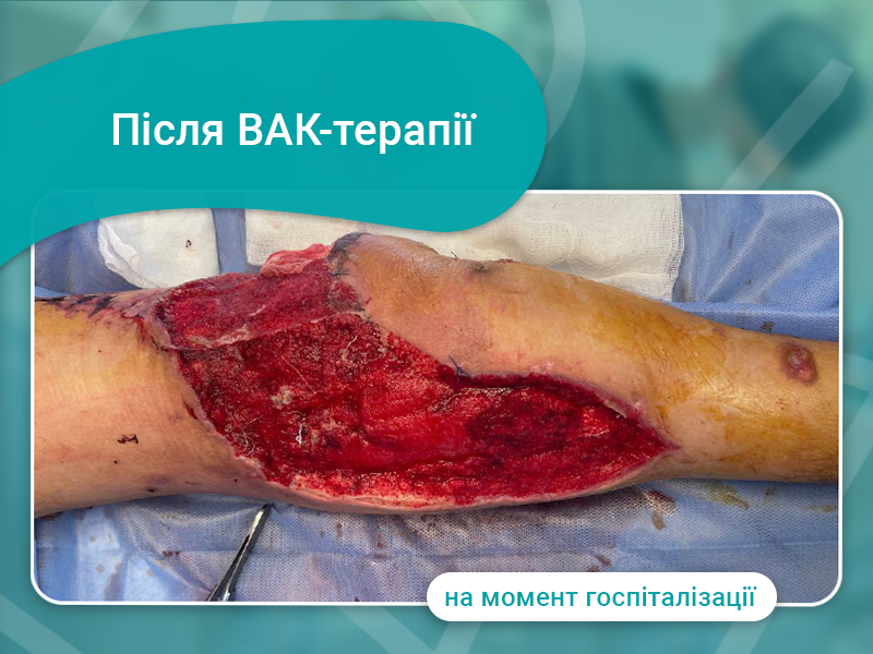вак-терапія