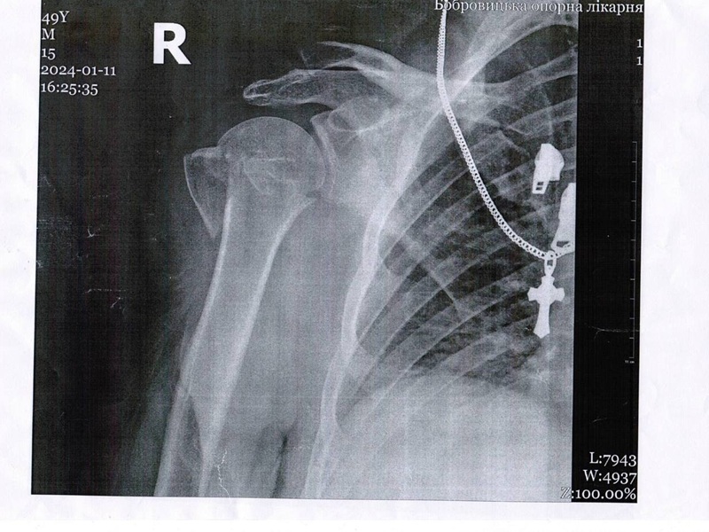 Металоостеосинтез плечевої кістки ДО Металоостеосинтез плечевої кістки ДО