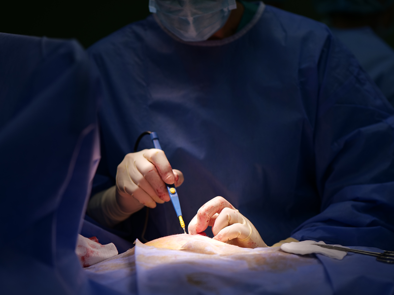 Резекція молочної залози в Києві секторальна резекція молочної залози