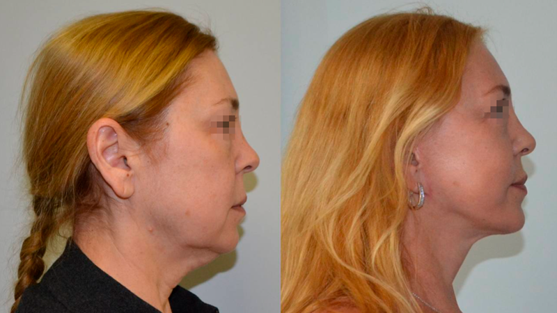 фейсліфтинг до після