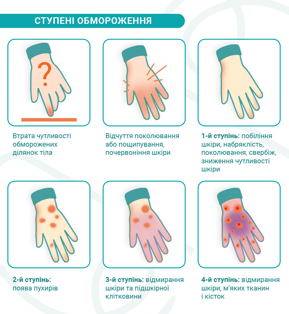 ступені обмороження_.jpg ступені обмороження