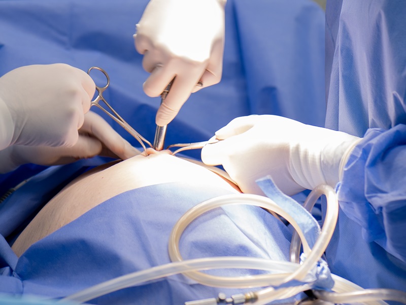 лапароскопія