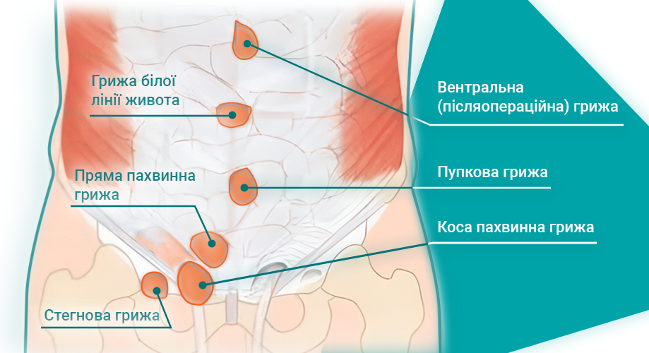 Види грижі Види грижі