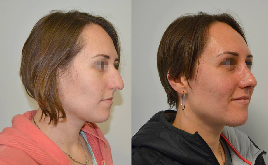 пластика носа