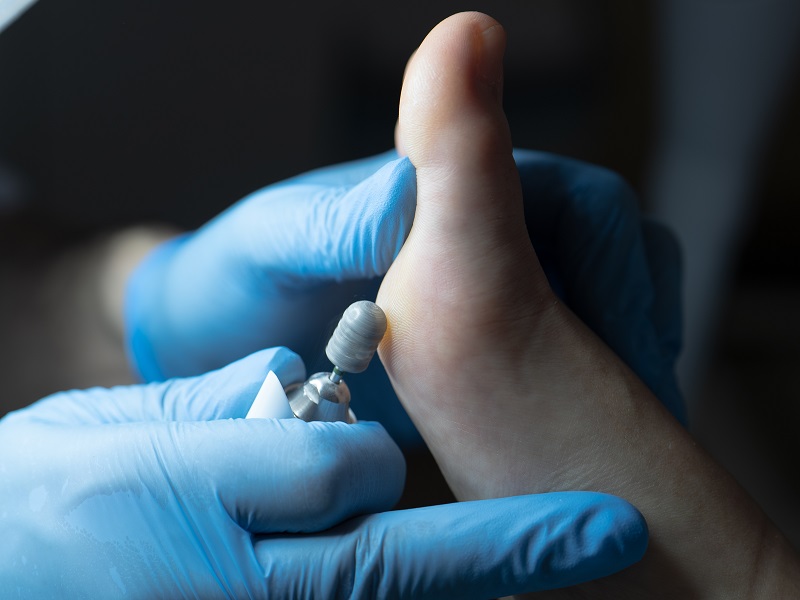 лікування мозолів