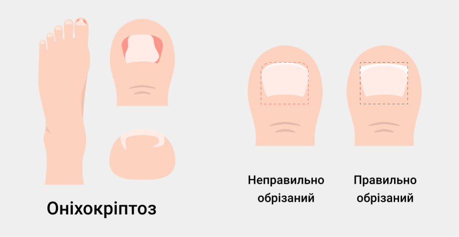 Симптоми оніхокріптоза