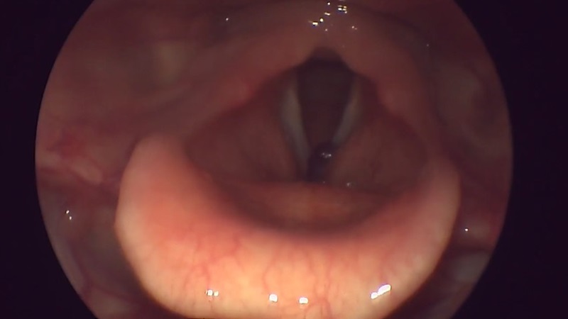 Опорно-підвісна мікроларингоскопія: кейс ларингоскопия