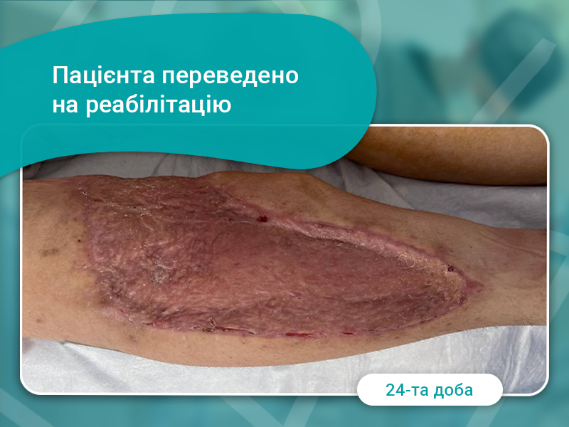 аутодермопластика