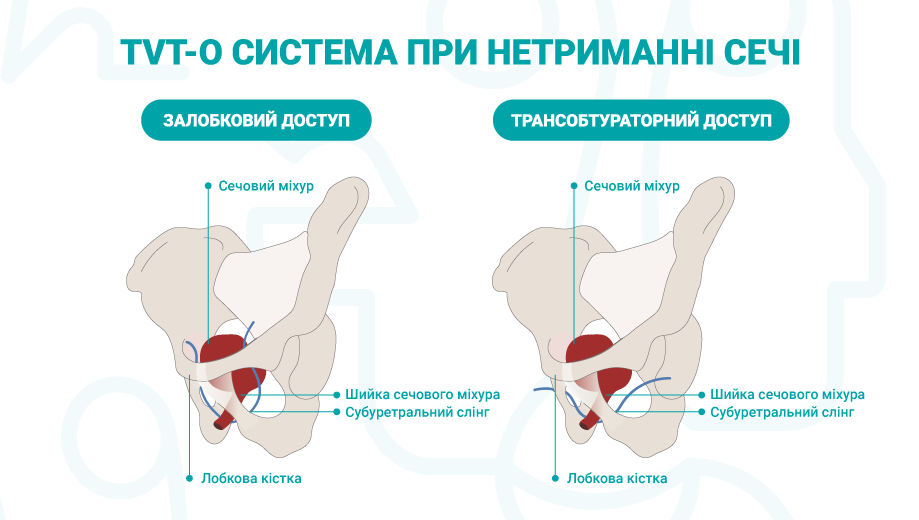 TVT-O система при нетриманні сечі нетримання сечі tvt-o