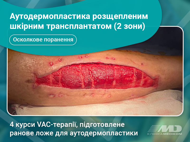 вак терапія