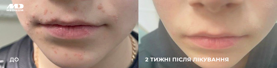 лікування плоских бородавок на обличчі