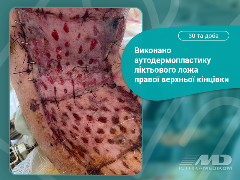 аутодермопластика