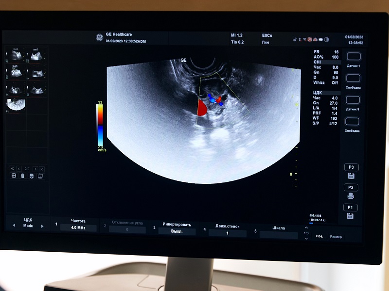 УЗД молочних залоз