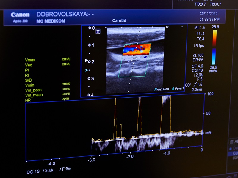УЗД судин голови