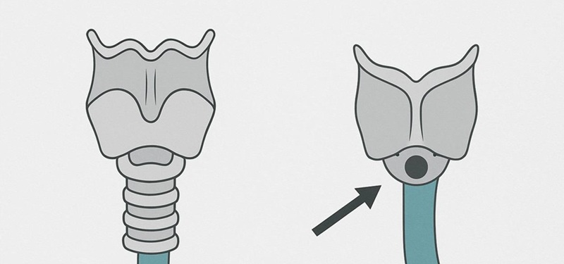Видалення гортані ларингектомія