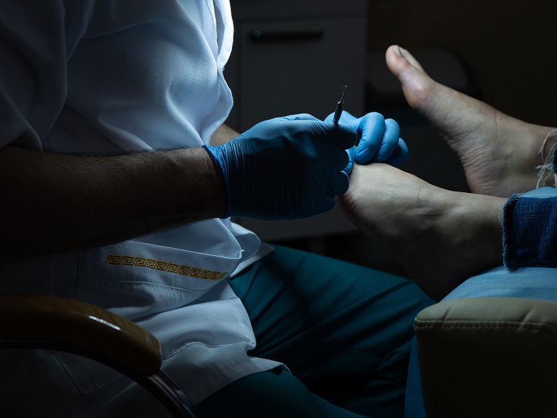 видалення мозолі