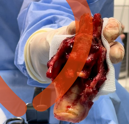 рак гортані