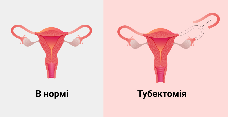 Тубектомія в Київі