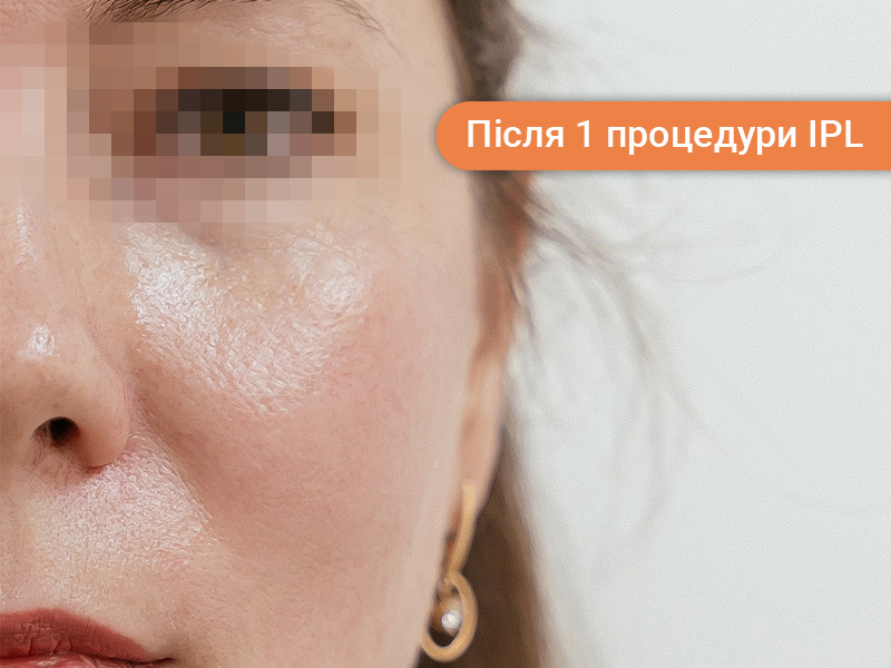 Лікування куперозу після.jpg Лікування куперозу