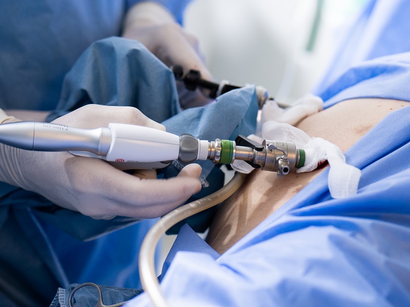 видалення пухлин в урології