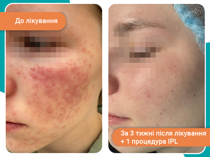 лікування розацеа лікування розацеа