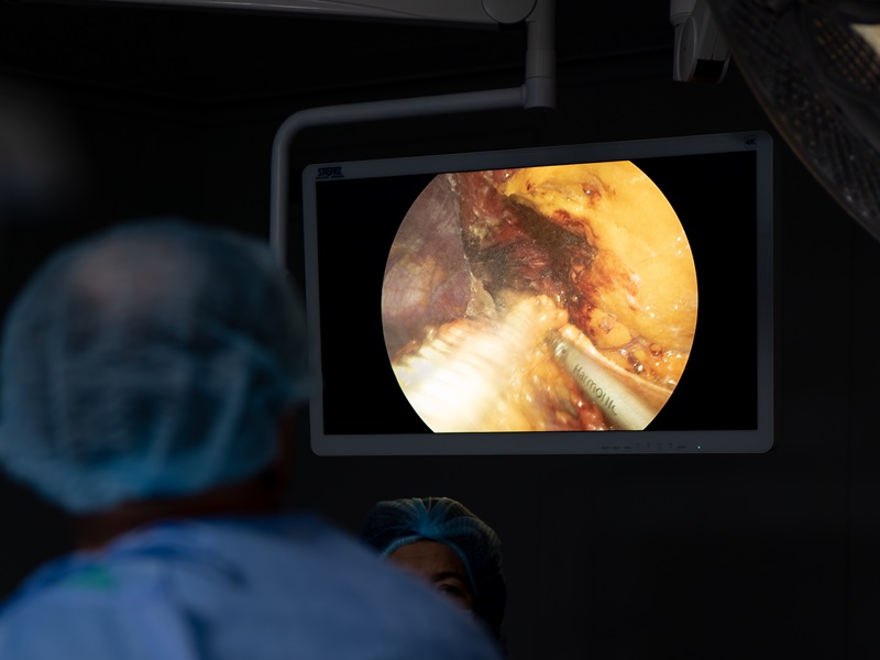 цистектомія